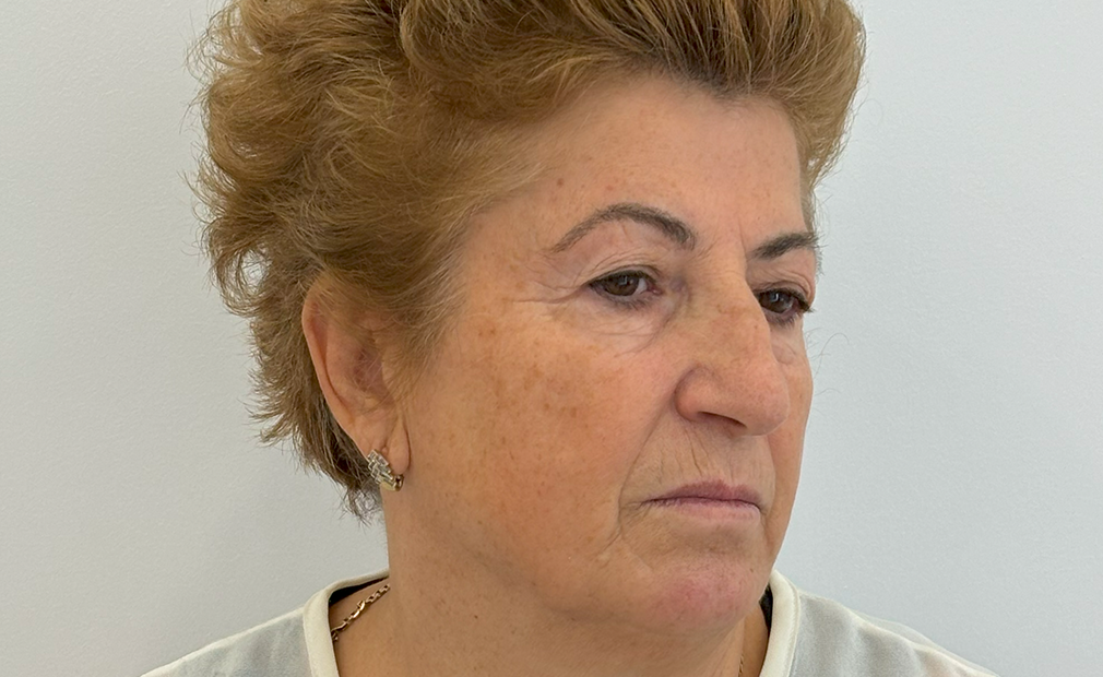 Blepharoplasty