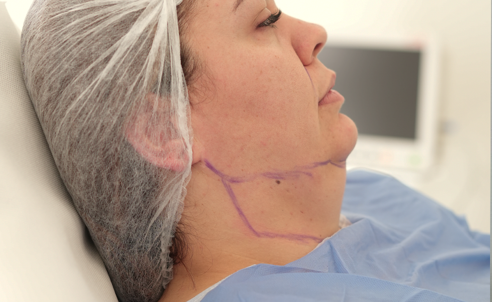 Double Chin Liposuction