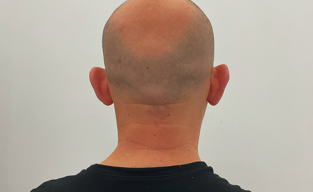 Otoplasty